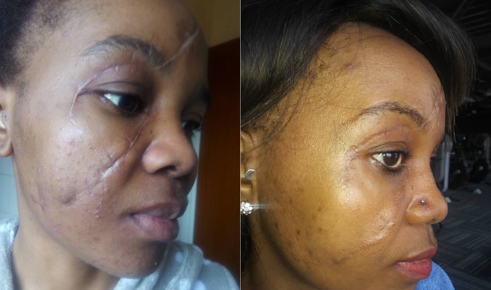 Before and after of a raised keloid scar