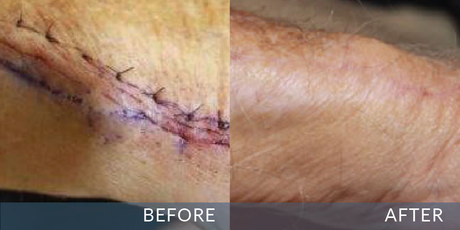 Before and after of a surgical scar fading