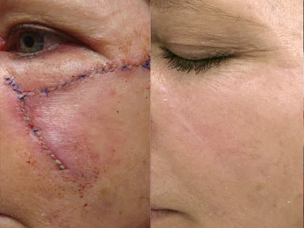 Surgical scar treatment progress