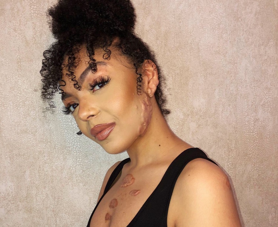Woman confident in her skin after using ScarErase scar cream