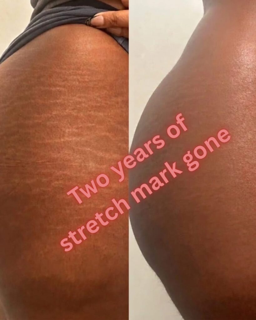 Customer scar improvement photo